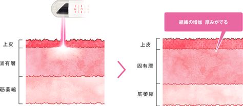 感度アップ|感度アップ手術「Gショット（不感症治療）」とは？。